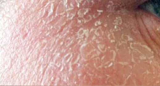 Hyaluronic Acid Anti-Allergy Essence