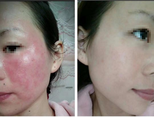 Sensitive skin soothing essential oil